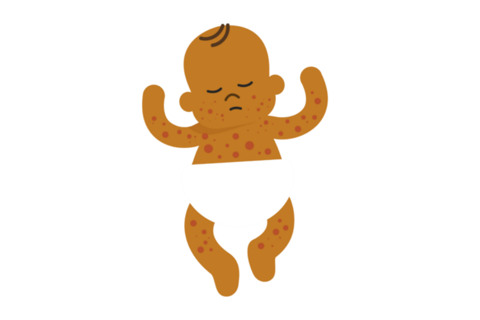 An illustration of a baby with a medium skin tone wearing a nappy. They appear to have a rash on their body and they are sleeping.