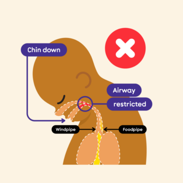 Illustration depicting baby's airways being restricted, as an illustrated baby's head is sitting on their chest. This is restricting their airways (ability to breathe).